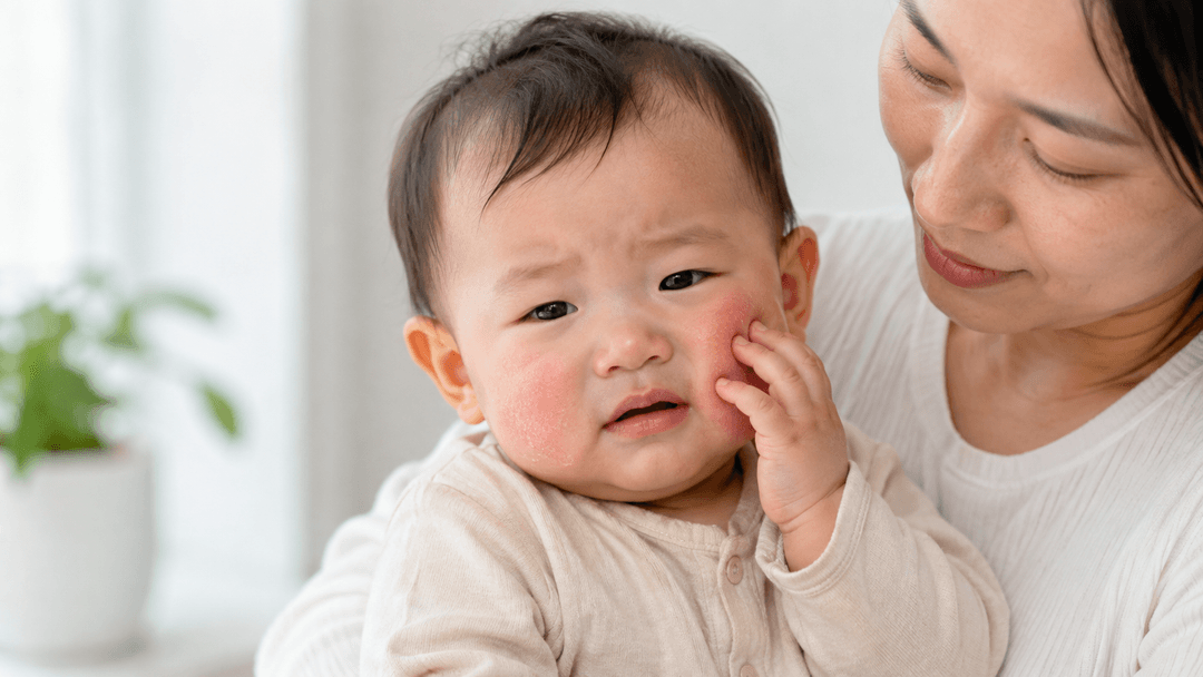 【嬰兒濕疹】BB紅面痕癢是奶癬？了解嬰兒濕疹症狀、濕疹戒口及食物關係
