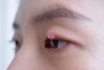 【眼挑針】眼皮紅腫生粒粒點算？了解眼挑針成因、症狀及治療方法