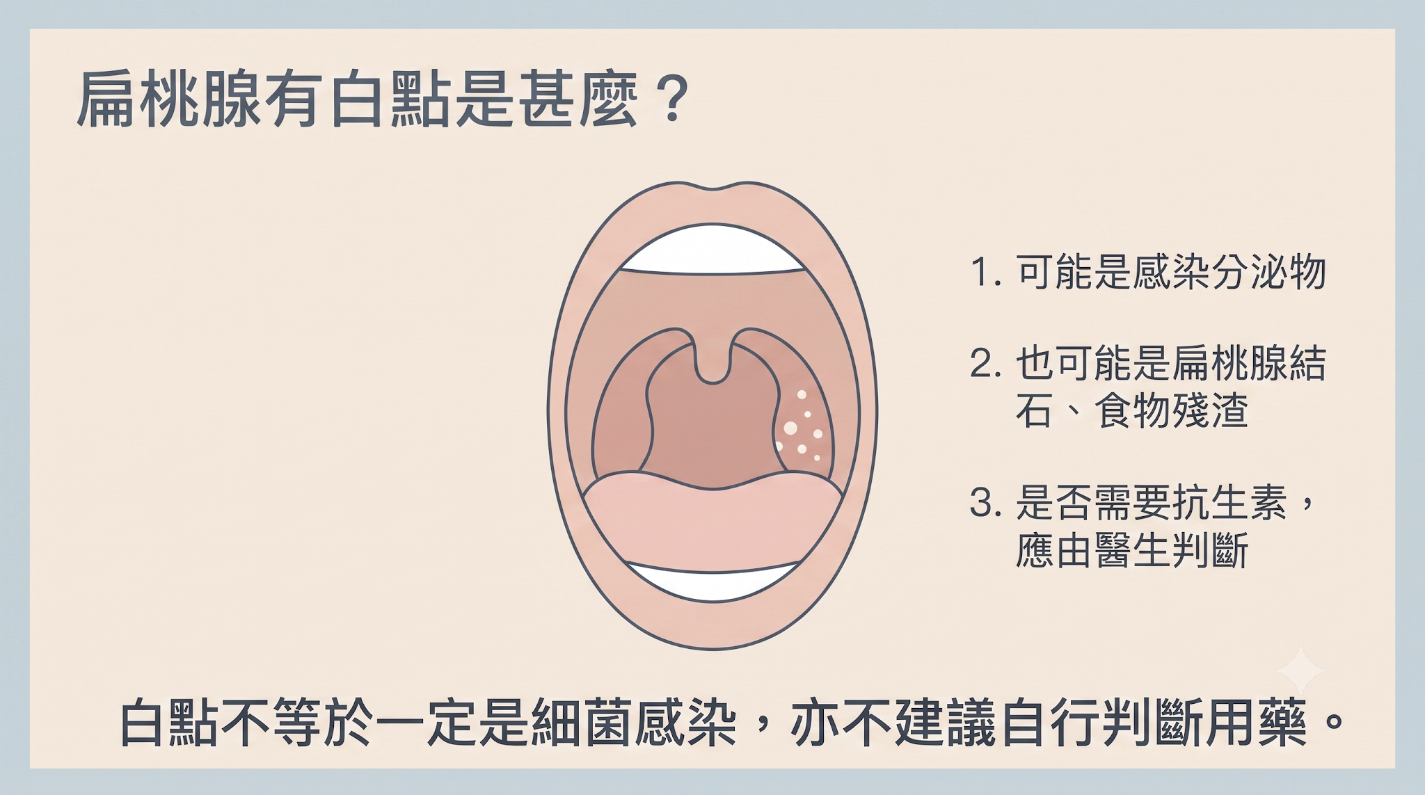 扁桃腺有白點原因圖，說明白點可能是感染分泌物、扁桃腺結石或食物殘渣，是否需要抗生素應由醫生判斷。